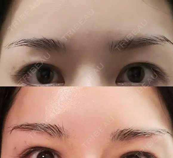 眉下切開 エイペックス美容外科 DAY 27 メイン用