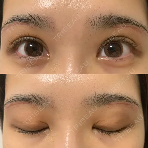 上まぶたの脂肪取り / 眉下切開 WOM CLINIC GINZA （ワム クリニック ギンザ） DAY 20 メイン用