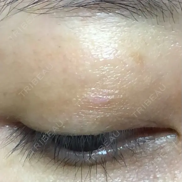 ほくろ・いぼ除去レーザー（肌） 仁愛クリニック DAY 25 メイン用