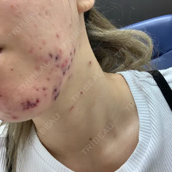 ニキビ治療 アサイクリニック 心斎橋本院 DAY 1 メイン用