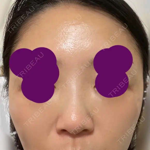 ヒアルロン酸注入（鼻） 新宿ビューティークリニック 新宿院 DAY 0 メイン用