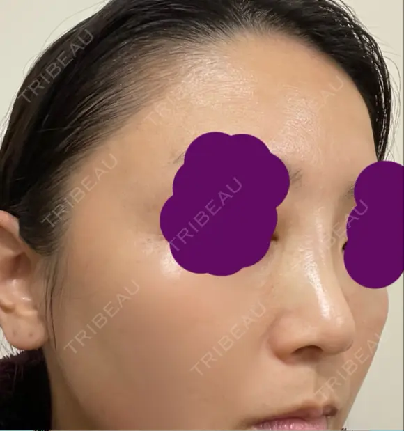 ヒアルロン酸注入（鼻） 新宿ビューティークリニック 新宿院 DAY 0 メイン用