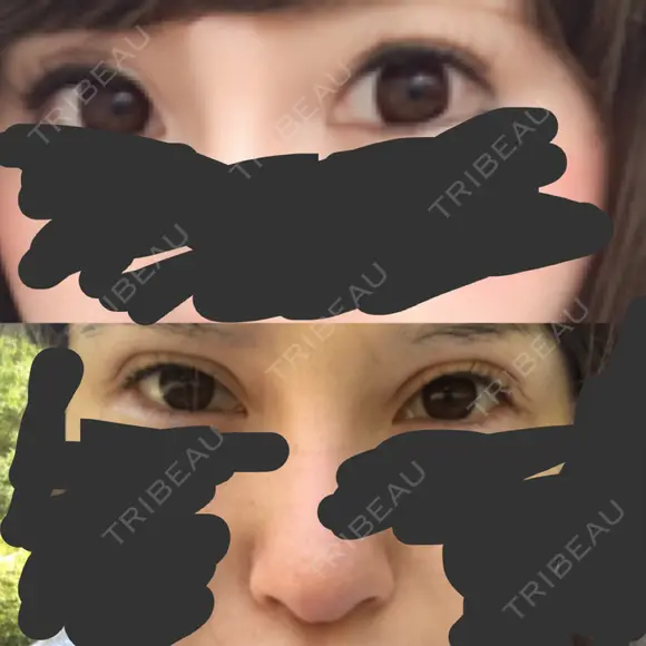 二重切開 牧野皮膚科形成外科内科医院 美容外科・形成外科・抗加齢医学外来 DAY 748 メイン用