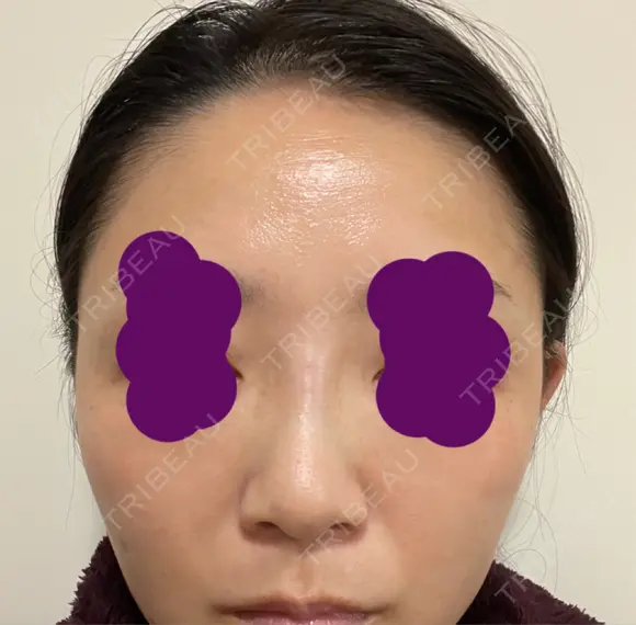 ヒアルロン酸注入（鼻） 新宿ビューティークリニック 新宿院 DAY 0 メイン用