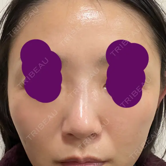 ヒアルロン酸注入（鼻） 新宿ビューティークリニック 新宿院 DAY 3 メイン用