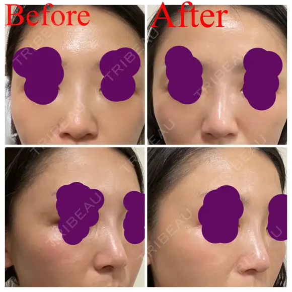 ヒアルロン酸注入（鼻） 新宿ビューティークリニック 新宿院 DAY 3 メイン用