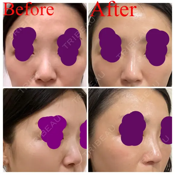 ヒアルロン酸注入（鼻） 新宿ビューティークリニック 新宿院 AFTER メイン用