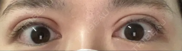 二重切開 恵聖会クリニック 心斎橋院 DAY 27 メイン用