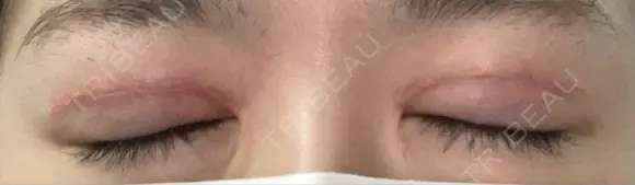 二重切開 恵聖会クリニック 心斎橋院 DAY 27 メイン用