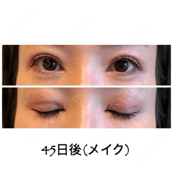 二重切開 / 目元修正 ビスポーククリニック 福岡院 DAY 45 メイン用