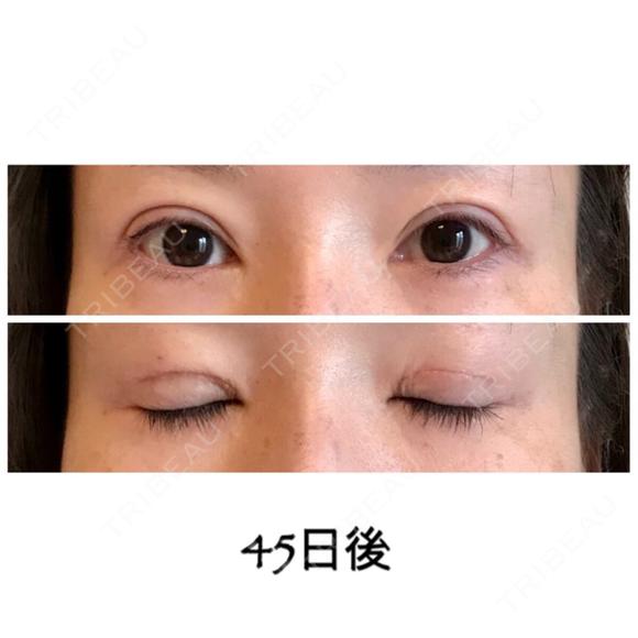 二重切開 / 目元修正 ビスポーククリニック 福岡院 DAY 45 メイン用