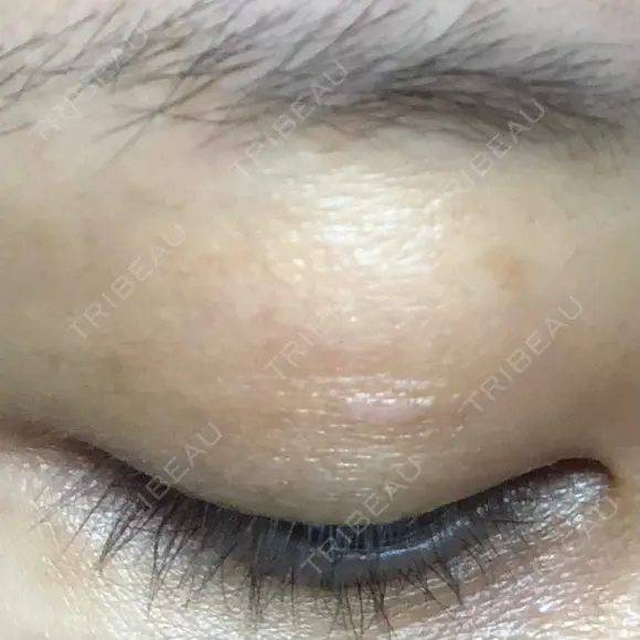 ほくろ・いぼ除去レーザー（肌） 仁愛クリニック DAY 28 メイン用