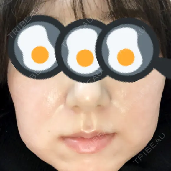 脂肪溶解注射（顔） 赤坂プレミアクリニック AFTER メイン用