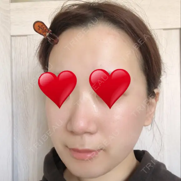 骨切り（あご） / 骨削り（エラ） リラ・クラニオフェイシャル・クリニック DAY 92 メイン用