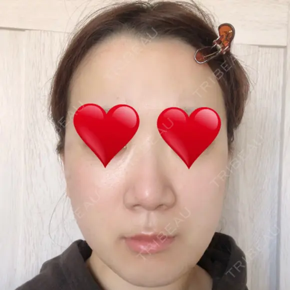 骨切り（あご） / 骨削り（エラ） リラ・クラニオフェイシャル・クリニック DAY 92 メイン用