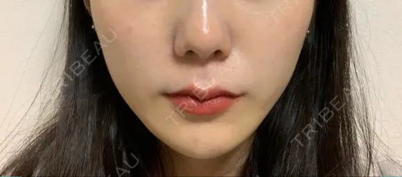 ヒアルロン酸注入（頬） 百人町アルファクリニック AFTER メイン用