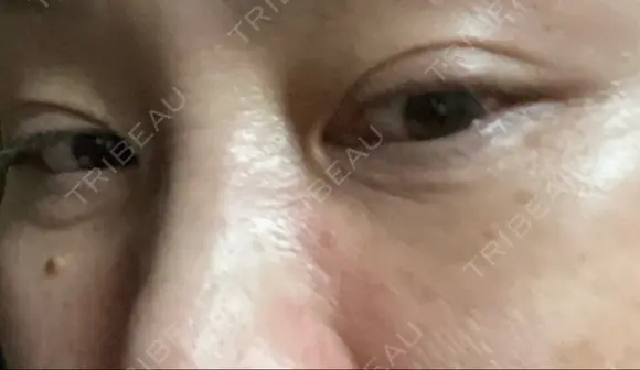 下まぶたたるみ取り / 下まぶたの脂肪取り ヨーダー公子クリニック眼科・美容皮膚科 横浜六浦院 DAY 13 メイン用