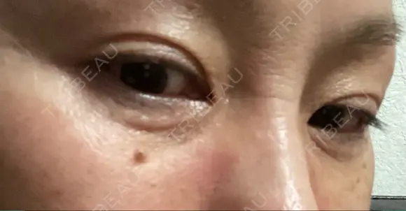 下まぶたたるみ取り / 下まぶたの脂肪取り ヨーダー公子クリニック眼科・美容皮膚科 横浜六浦院 DAY 13 メイン用