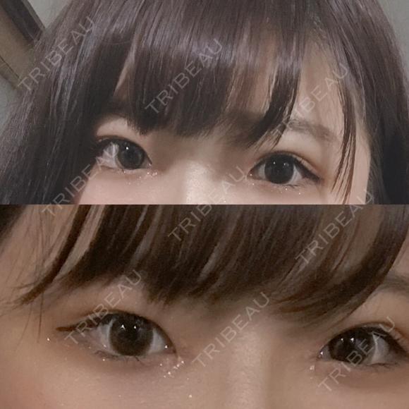 二重埋没 / 目頭切開 湘南美容クリニック 京都院 AFTER メイン用