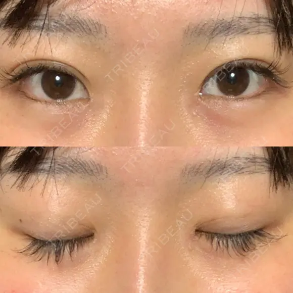 蒙古ひだ形成 R.O.clinic DAY 13 メイン用