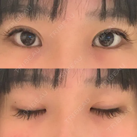 蒙古ひだ形成 R.O.clinic DAY 13 メイン用