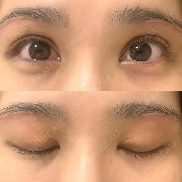 上まぶたの脂肪取り / 眉下切開 WOM CLINIC GINZA （ワム クリニック ギンザ） DAY 29 メイン用