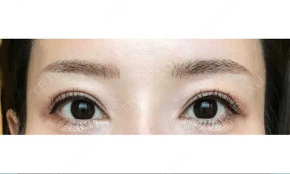 アートメイク（眉） GRACIA clinic 【グラシアクリニック】 DAY 3 メイン用