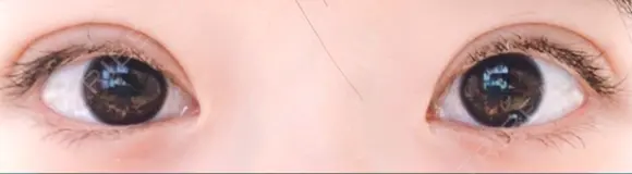 二重切開 / 目元修正 水の森美容クリニック 名古屋院 DAY 61 メイン用