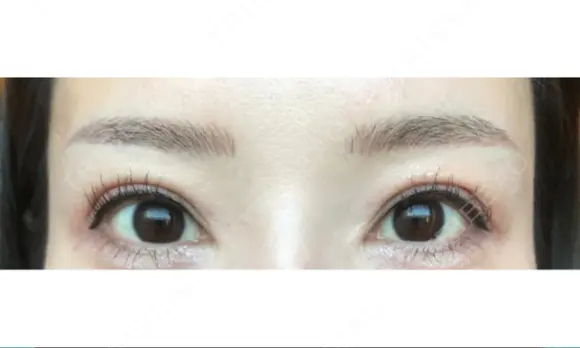 アートメイク（眉） GRACIA clinic 【グラシアクリニック】 DAY 5 メイン用