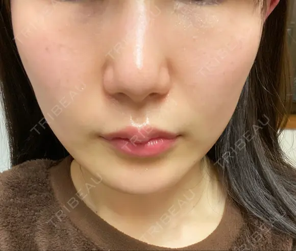 フォトRF 湘南美容クリニック 柏院 DAY 0 メイン用
