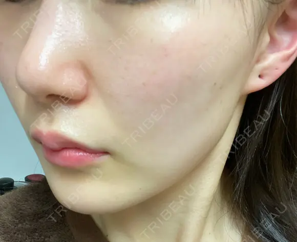 フォトRF 湘南美容クリニック 柏院 DAY 0 メイン用
