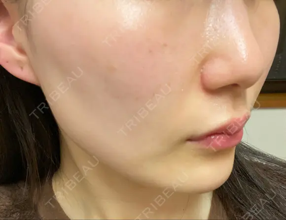 フォトRF 湘南美容クリニック 柏院 DAY 0 メイン用