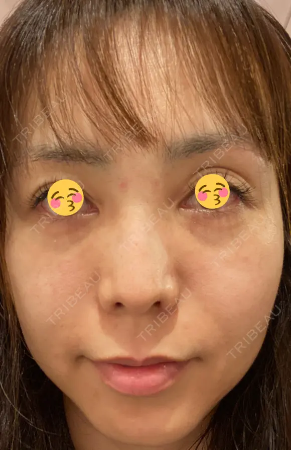 クマ治療 / 再生医療 / PRP皮膚再生療法 銀座よしえクリニック 銀座院 DAY 49 メイン用