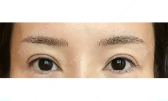 アートメイク（眉） GRACIA clinic 【グラシアクリニック】 DAY 7 メイン用