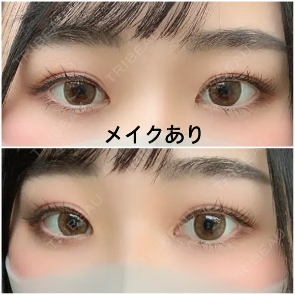 二重切開 / 上まぶたたるみ取り 広島プルミエクリニック AFTER メイン用