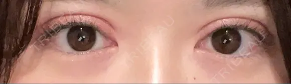 二重切開 恵聖会クリニック 心斎橋院 DAY 37 メイン用