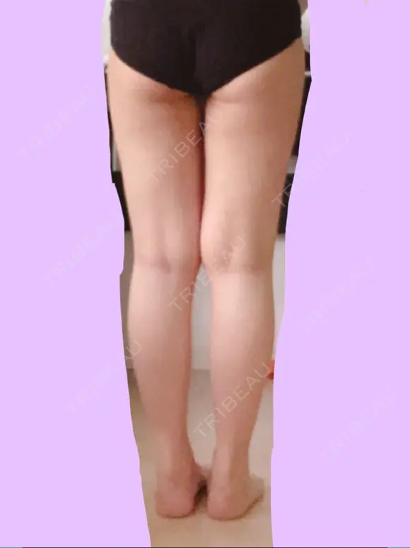脂肪吸引（脚） 宇都宮竹内クリニック DAY 59 メイン用