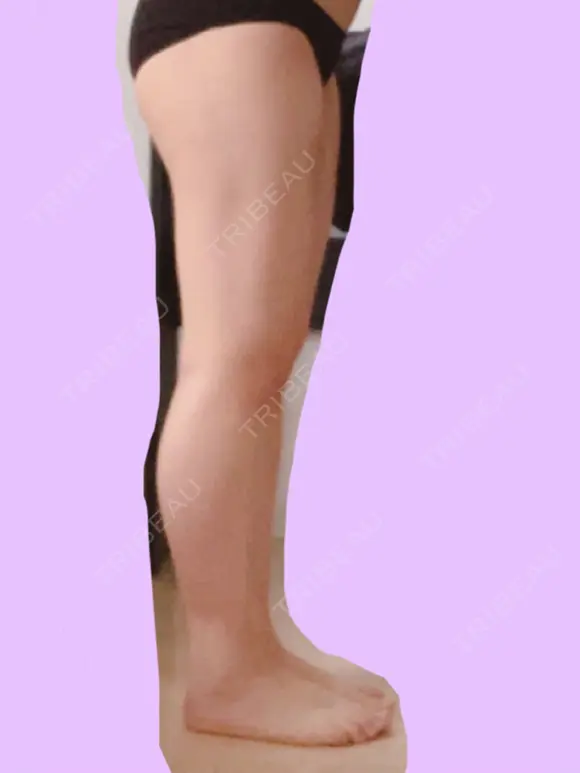 脂肪吸引（脚） 宇都宮竹内クリニック DAY 59 メイン用