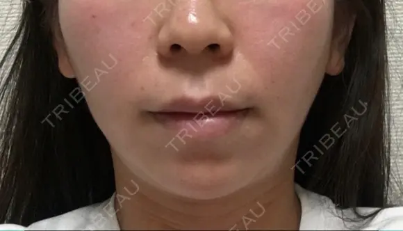 バッカルファット除去 / 脂肪吸引（顔） 湘南美容クリニック 那覇院 AFTER メイン用