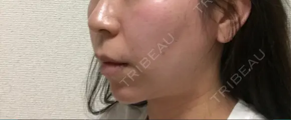 バッカルファット除去 / 脂肪吸引（顔） 湘南美容クリニック 那覇院 DAY 216 メイン用