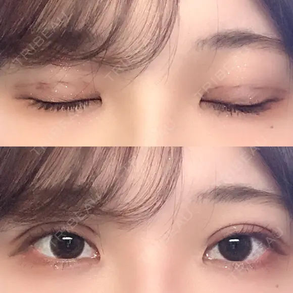 二重埋没 湘南美容クリニック 金沢院 DAY 2 メイン用