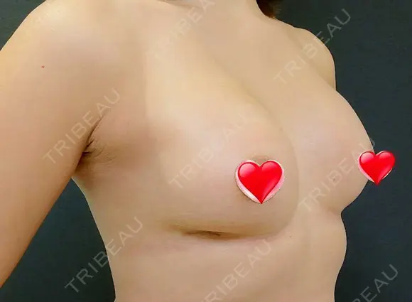 豊胸（シリコンバッグ） 表参道スキンクリニック 名古屋院（DAILY SKIN CLINIC提携院） DAY 35 メイン用