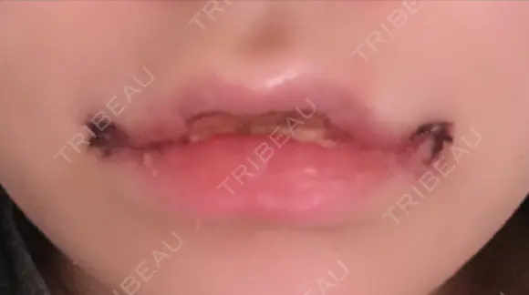 口唇縮小術 / 口角挙上 B-LINE CLINIC 池袋院 DAY 5 メイン用