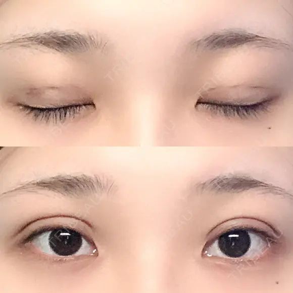 二重埋没 湘南美容クリニック 金沢院 DAY 3 メイン用