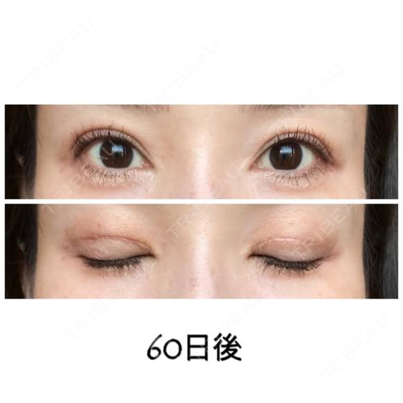 二重切開 / 目元修正 ビスポーククリニック 福岡院 DAY 60 メイン用