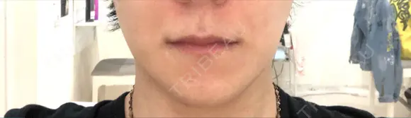 骨切り（あご） / 骨削り（エラ） 加藤クリニック 麻布東京院 AFTER メイン用