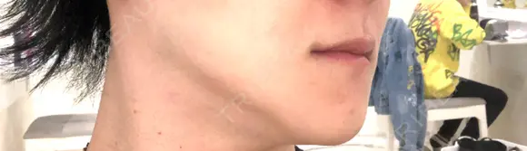 骨切り（あご） / 骨削り（エラ） 加藤クリニック 麻布東京院 DAY 128 メイン用