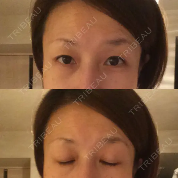 目尻切開 湘南美容クリニック 秋葉原院 DAY 65 メイン用
