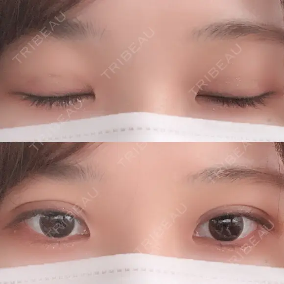 二重埋没 湘南美容クリニック 金沢院 DAY 5 メイン用