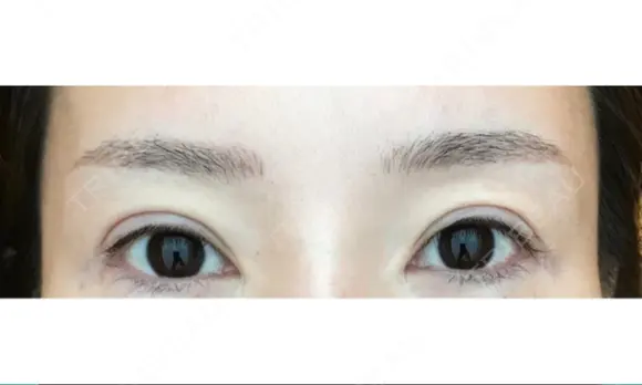 アートメイク（眉） GRACIA clinic 【グラシアクリニック】 DAY 14 メイン用